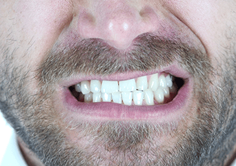 sleep bruxism causes
